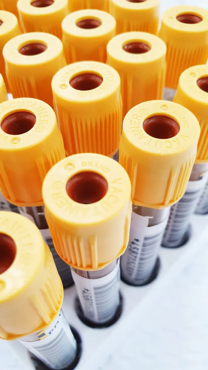 Tubos de extracción de sangre con tapón amarillo listos para un análisis de laboratorio